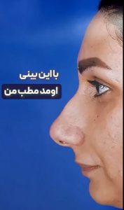 نمونه کار عمل بینی گوشتی در رشت _ دکتر علی حسینی واجاری 