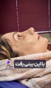 قبل و بعد عمل بینی گوشتی در رشت _ دکتر حسینی واجاری