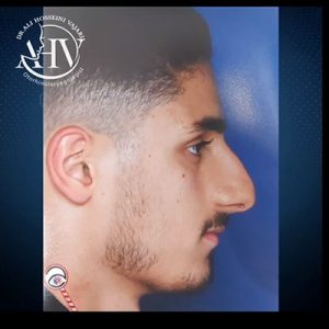 قبل و بعد عمل بینی گوشتی _ دکتر علی حسینی واجاری