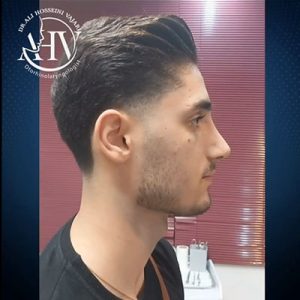 نمونه کار عمل بینی گوشتی _ دکتر علی حسینی واجاری