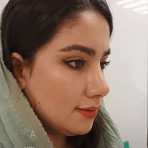 رفع جای بخیه عمل بینی در رشت _ دکتر علی حسینی واجاری