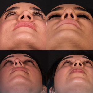 عکس عدم تقارن سوراخ های بینی _ دکتر علی حسینی واجاری