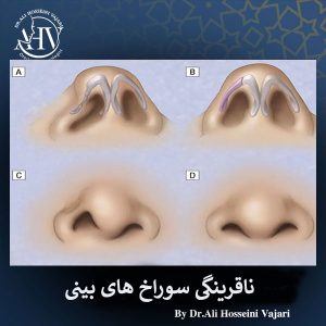 عدم تقارن سوراخ های بینی بعد از عمل _ دکتر علی حسینی واجاری
