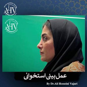 عمل بینی استخوانی در رشت _ دکتر علی حسینی واجاری