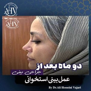 عمل بینی استخوانی در رشت _ دکتر علی حسینی واجاری
