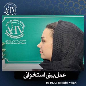 جراحی بینی استخوانی در رشت _ دکتر علی حسینی واجاری
