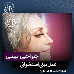 جراحی بینی استخوانی در رشت _ دکتر علی حسینی واجاری