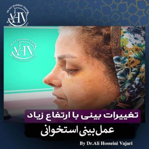 رینوپلاستی استخوانی در رشت _ دکتر علی حسینی واجاری