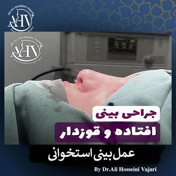 عمل بینی استخوانی در رشت _ دکتر علی حسینی واجاری