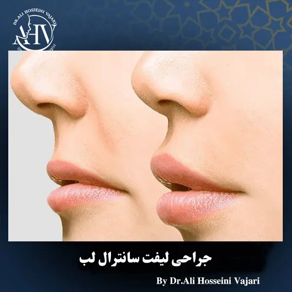 عکس جراحی لیفت سانترال لب _ دکتر علی حسینی واجاری