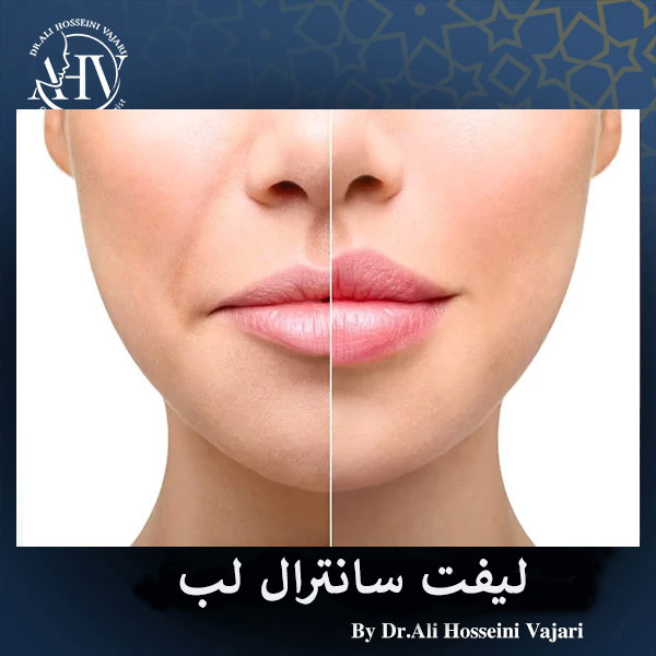لیفت سانترال لب _ دکتر علی حسینی واجاری