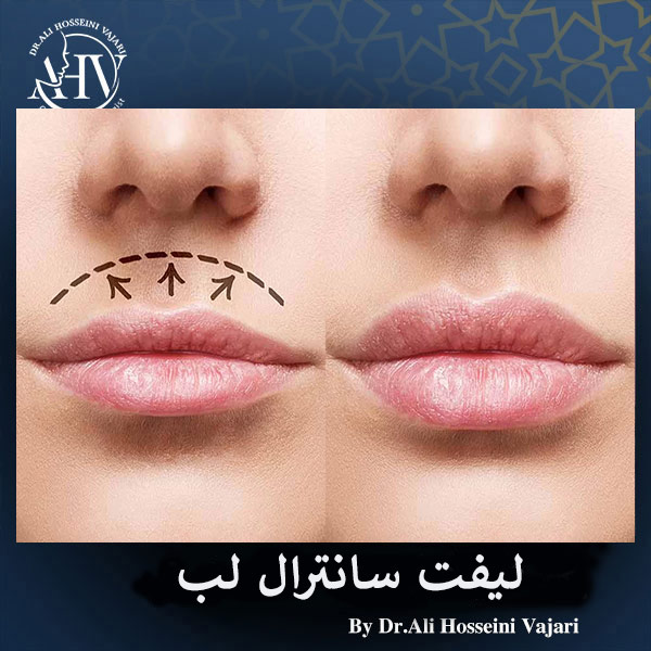 جراحی لیفت سانترال لب _ دکتر علی حسینی واجاری
