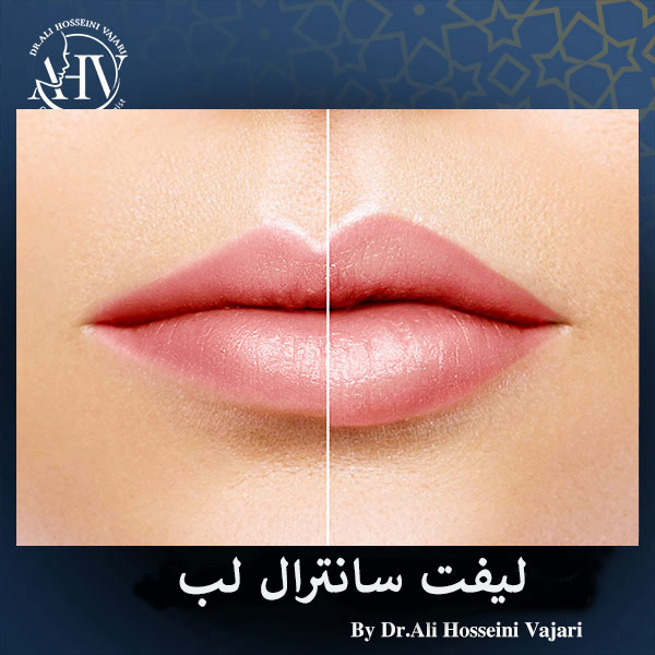 عمل لیفت سانترال لب _ دکتر علی حسینی واجاری