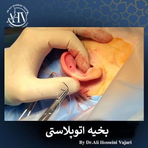 رفع جای بخیه اتوپلاستی _ دکتر علی حسینی واجاری