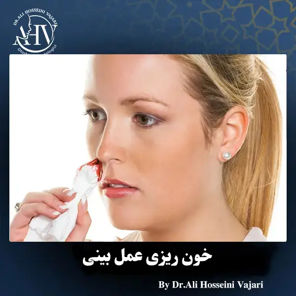 خون ریزی بعد از عمل بینی _ دکتر علی حسینی واجاری