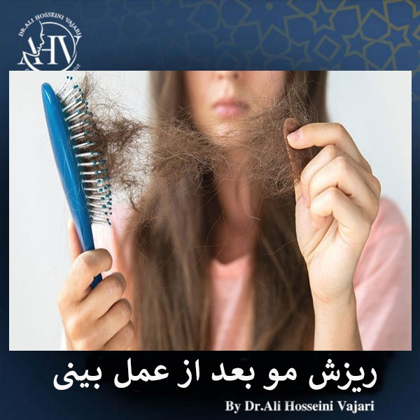 ریزش مو بعد از عمل بینی _ دکتر علی حسینی واجاری