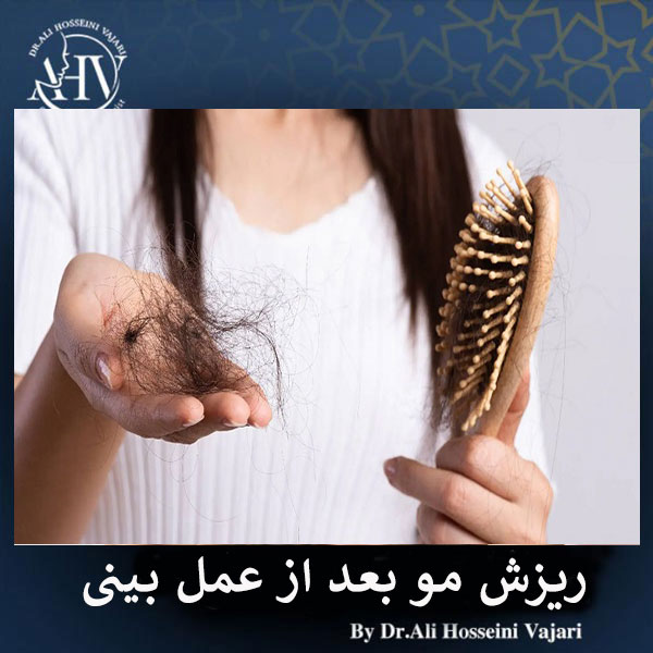 ریزش مو بعد از جراحی بینی _ دکتر علی حسینی واجاری