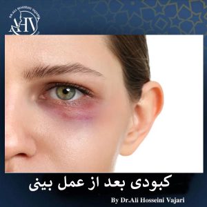 کبودی بعد از عمل بینی _ دکتر علی حسینی واجاری