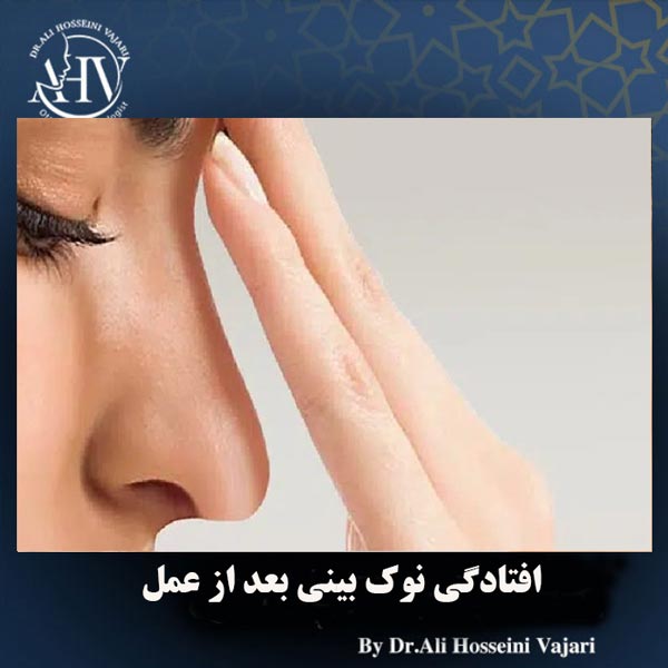 افتادگی نوک بینی بعد از عمل _ دکتر علی حسینی واجاری