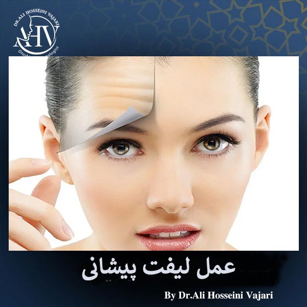 عمل لیفت پیشانی _ دکتر علی حسینی واجاری