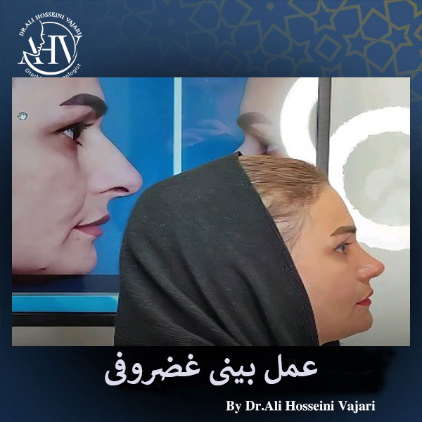 جراحی بینی غضروفی _ دکتر علی حسینی واجاری