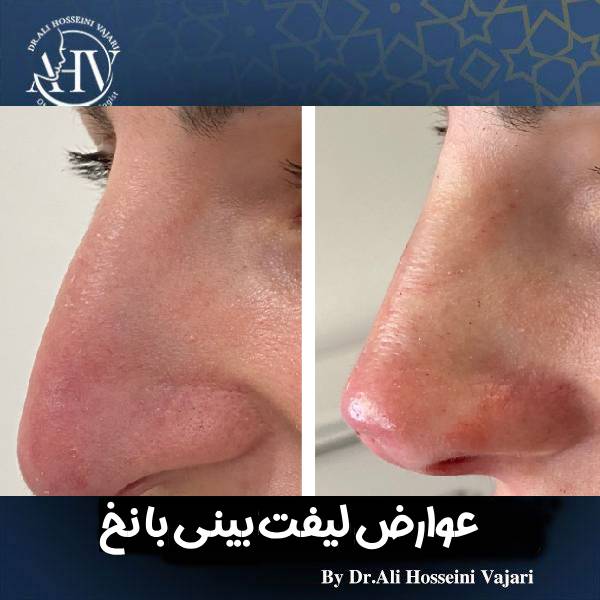 عوارض لیفت بینی با نخ
