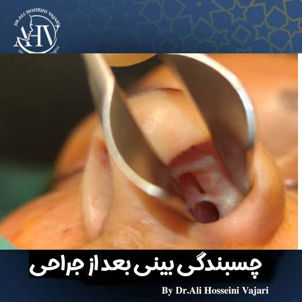 چسبندگی بینی بعد از جراحی