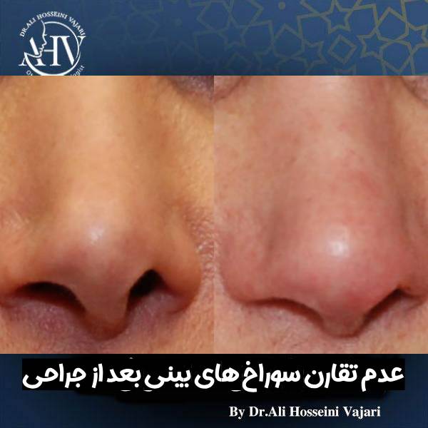 عدم تقارن سوراخ های بینی بعد از جراحی