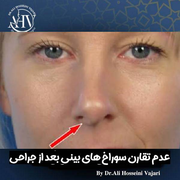عدم تقارن سوراخ های بینی بعد از جراحی