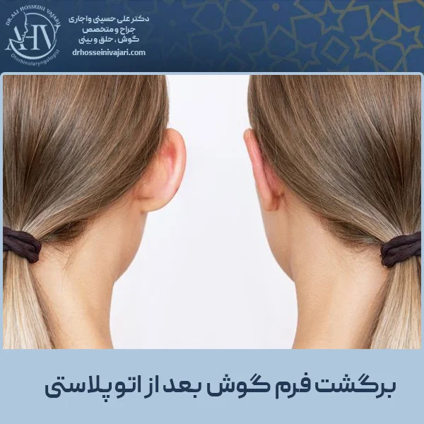 برگشت فرم گوش بعد از اتوپلاستی - دکتر واجارای